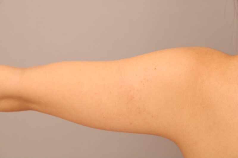 ベイザー脂肪吸引(2か月半経過:24)の術前写真