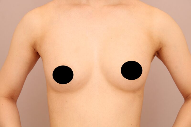 脂肪豊胸で自然でより理想のシルエットに近い美バストに！