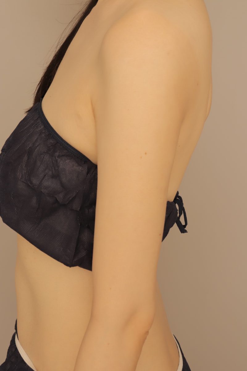 ベイザー脂肪吸引(半年経過:33)の術後写真