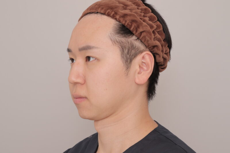 ベイザー脂肪吸引（6ヶ月経過：31）の術前写真