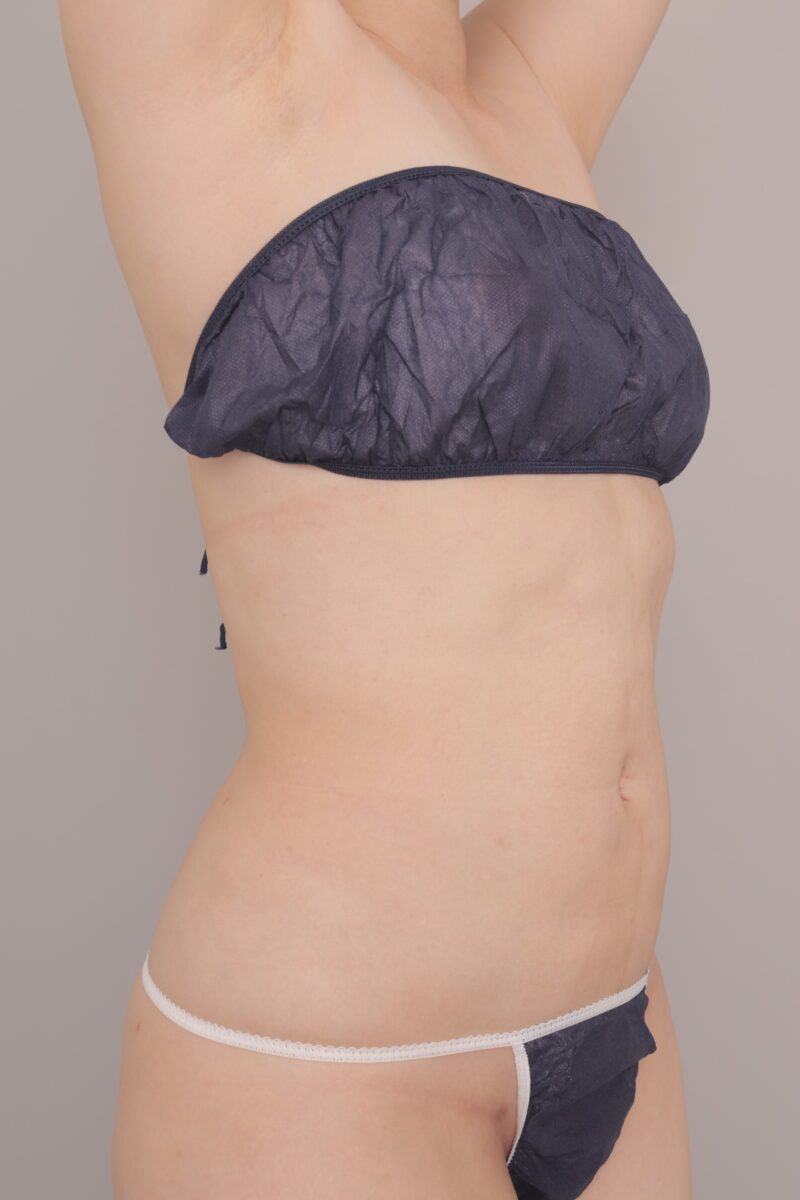 ベイザー脂肪吸引(3ヶ月経過:40)の術後写真