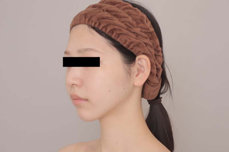 小顔美人がさらに垢抜け！50ccの頬＋顎下吸引で左右差も解消し、横顔美人度UP【3ヶ月】●