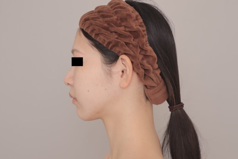 ベイザー脂肪吸引(3ヶ月経過:24)の術後写真