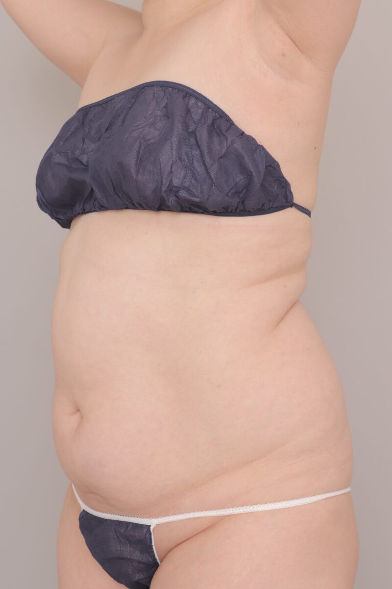 ベイザー脂肪吸引(3ヶ月経過:45)の術前写真