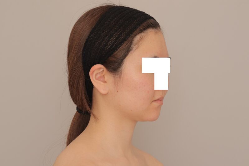 ベイザー脂肪吸引(半年経過:24)の術前写真