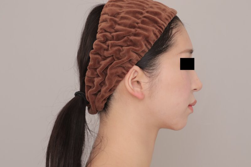 顔の脂肪吸引注射は意味ないっすよ！part2●