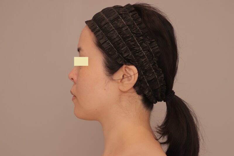 ベイザー脂肪吸引(半年経過:38)の術前写真