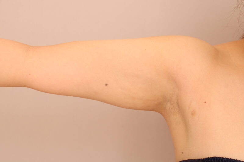 40代以降で上腕・肩の脂肪吸引をする際のポイント