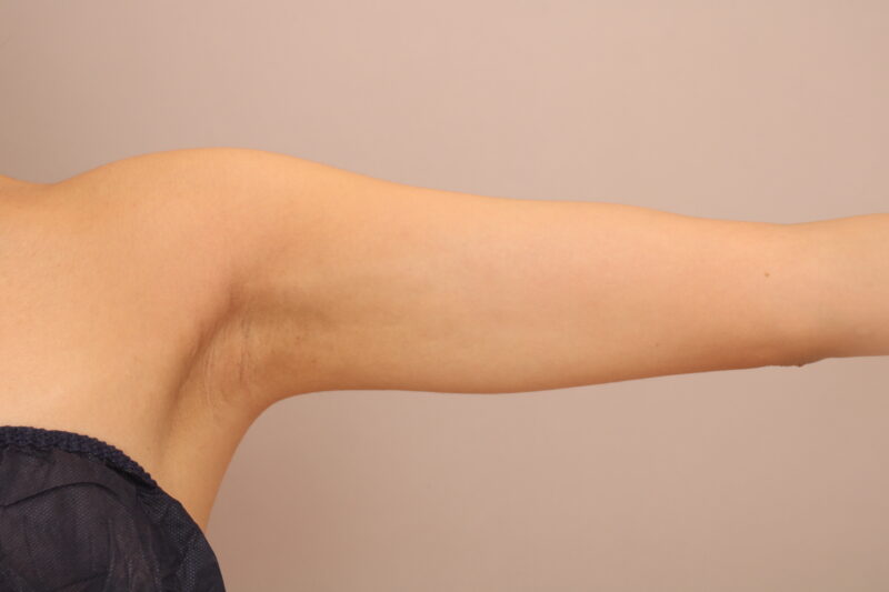 骨格ストレートは二の腕＋肩の脂肪吸引がおススメです！