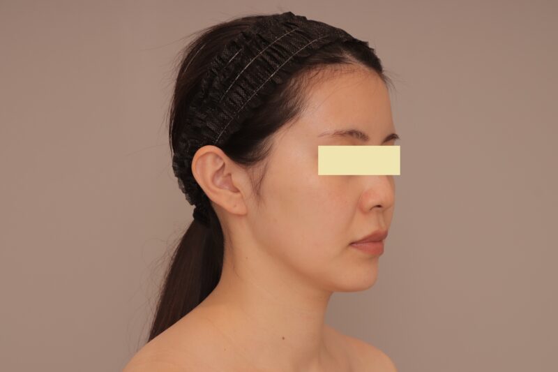 ベイザー脂肪吸引(半年経過:32)の術前写真