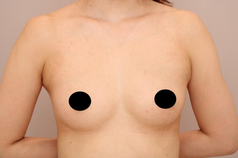 インプラント豊胸では難しい、自然豊胸のメリット