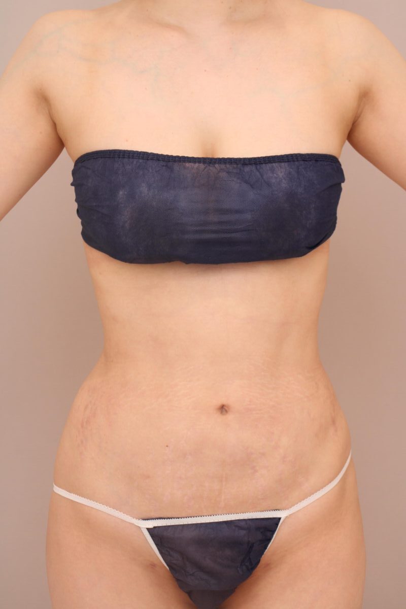 お腹と腰の脂肪吸引ですっきりとしたお腹周り綺麗なくびれを作ります！