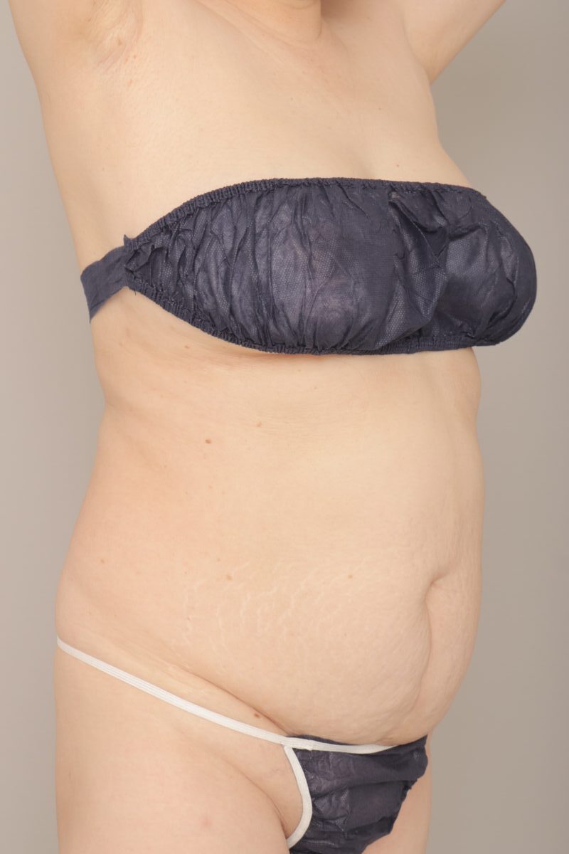 ベイザー脂肪吸引（１ヶ月経過：57）の術前写真