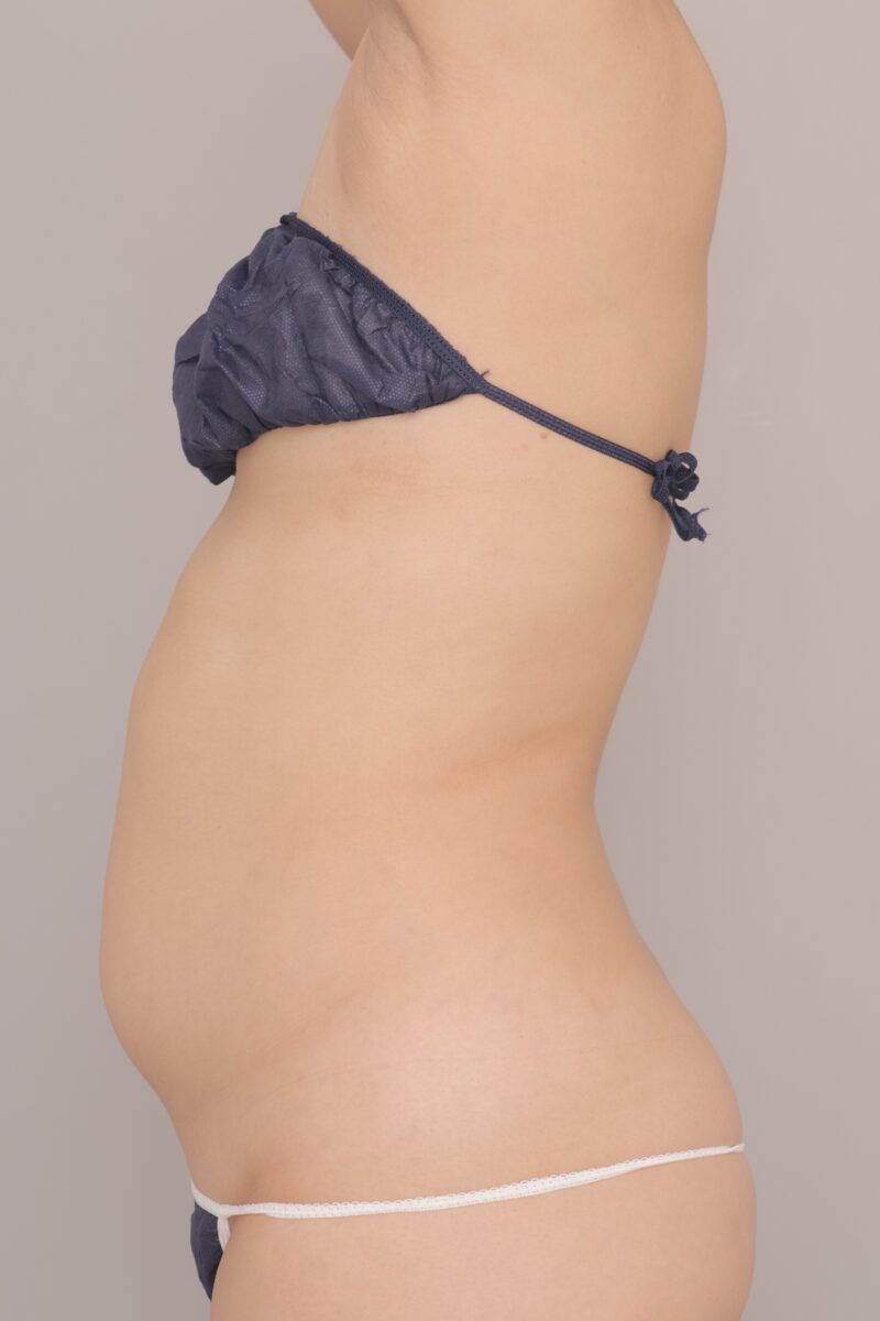 ベイザー脂肪吸引（1ヶ月経過：29）の術前写真