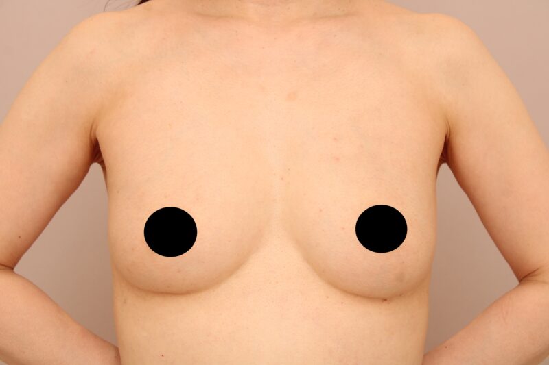 脂肪豊胸でメリハリのある綺麗なシルエットのバストに！