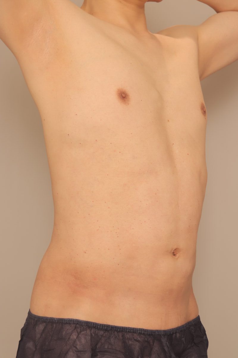 ベイザー脂肪吸引(3ヶ月経過:55)の術後写真