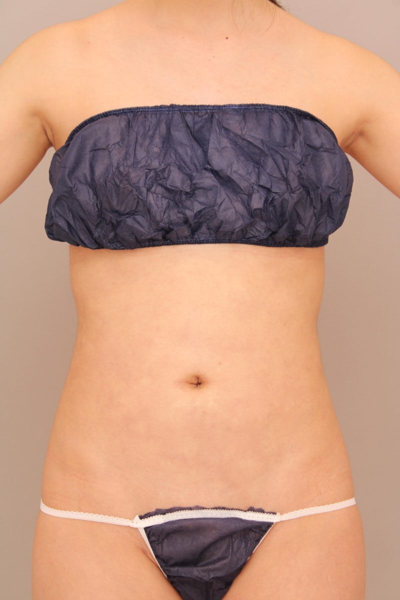 お腹や腰のダイエットだけでは難しい部位を効果的に脂肪吸引！