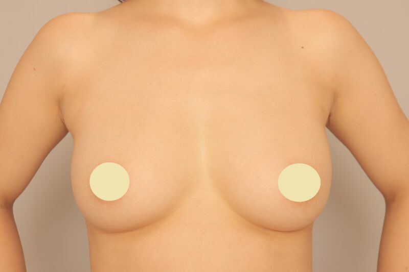 ★脂肪豊胸は回数を重ねると……!!