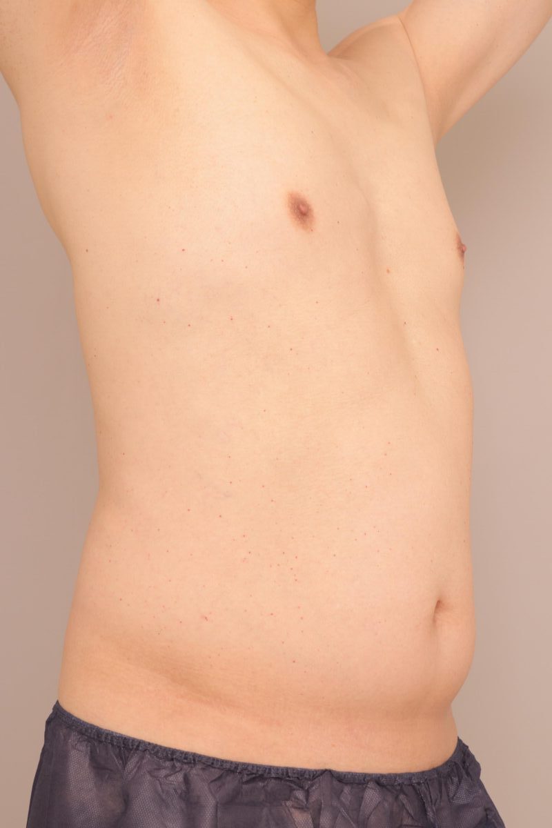 ベイザー脂肪吸引(3ヶ月経過:55)の術前写真