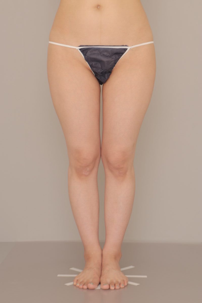 ベイザー脂肪吸引(3ヶ月経過:31)の術前写真