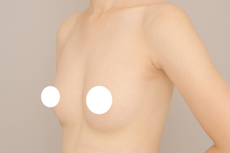 ベイザー脂肪吸引(3ヶ月経過:25)の術後写真