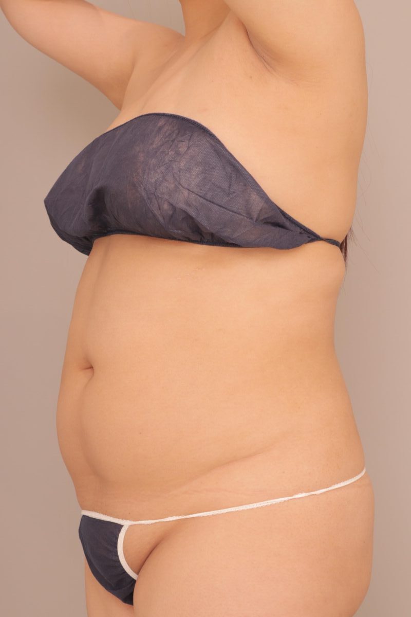 ベイザー脂肪吸引(3ヶ月経過:33)の術前写真