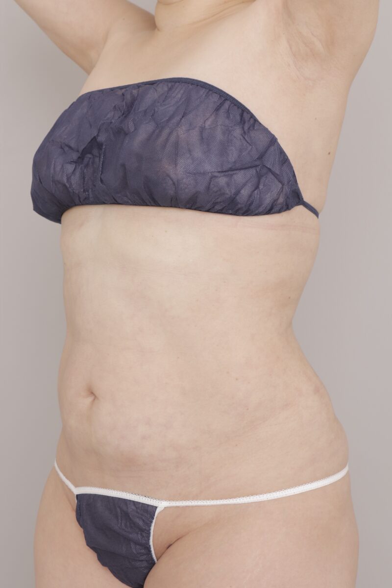 3ヶ月でここまで変化！5,100cc吸引で“厚みゼロ”の美ボディラインに