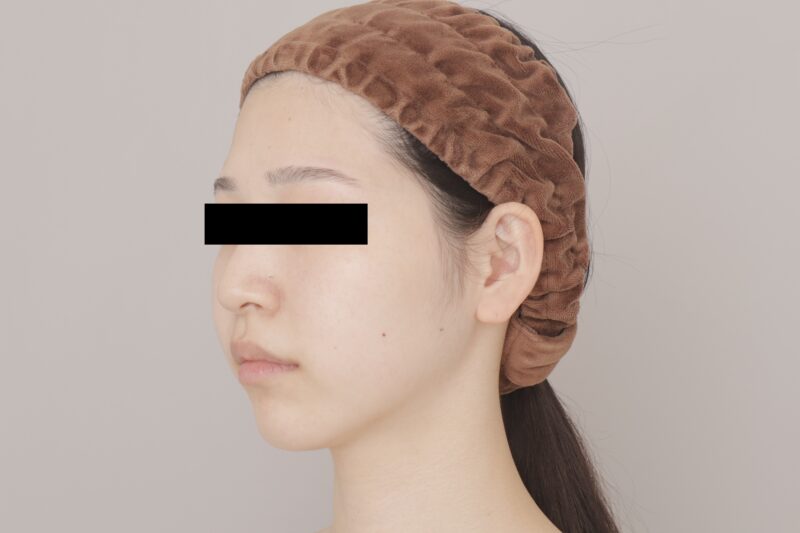 ベイザー脂肪吸引（6ヶ月経過：24）の術前写真