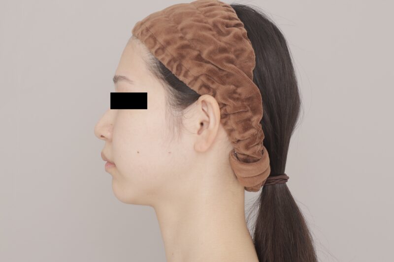 ベイザー脂肪吸引(3ヶ月経過:24)の術前写真