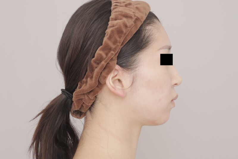 ベイザー脂肪吸引（3ヶ月経過：21）の術前写真