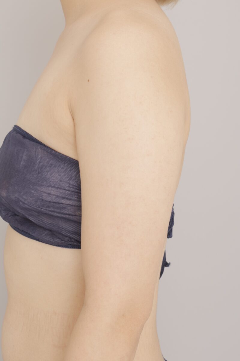 ベイザー脂肪吸引（3ヶ月経過：30）の術前写真