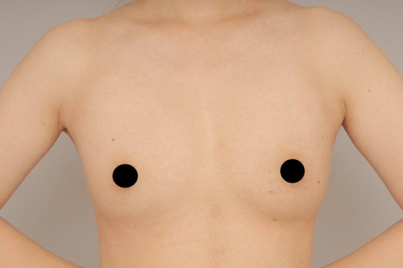 コンデンスリッチ豊胸3カ月目♪　モニター様の3か月経過をご紹介♪　34歳 167cm 54kg