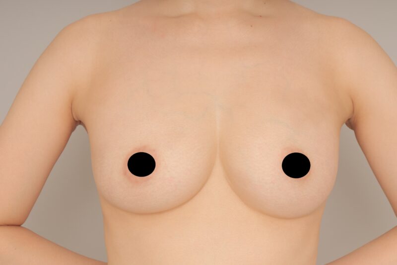 ベイザー脂肪吸引（1ヵ月経過：35）の術後写真