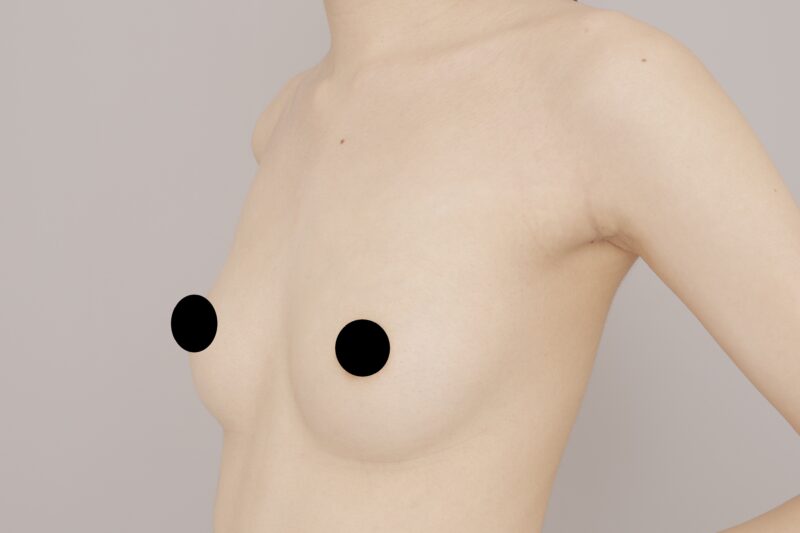 ベイザー脂肪吸引（6ヶ月経過：25）の術前写真