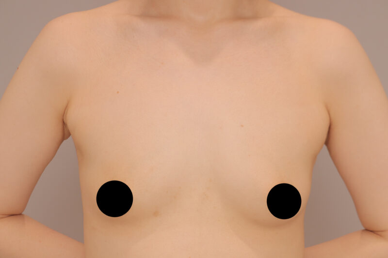 ベイザー脂肪吸引（1年2ヶ月後経過：45）の術前写真