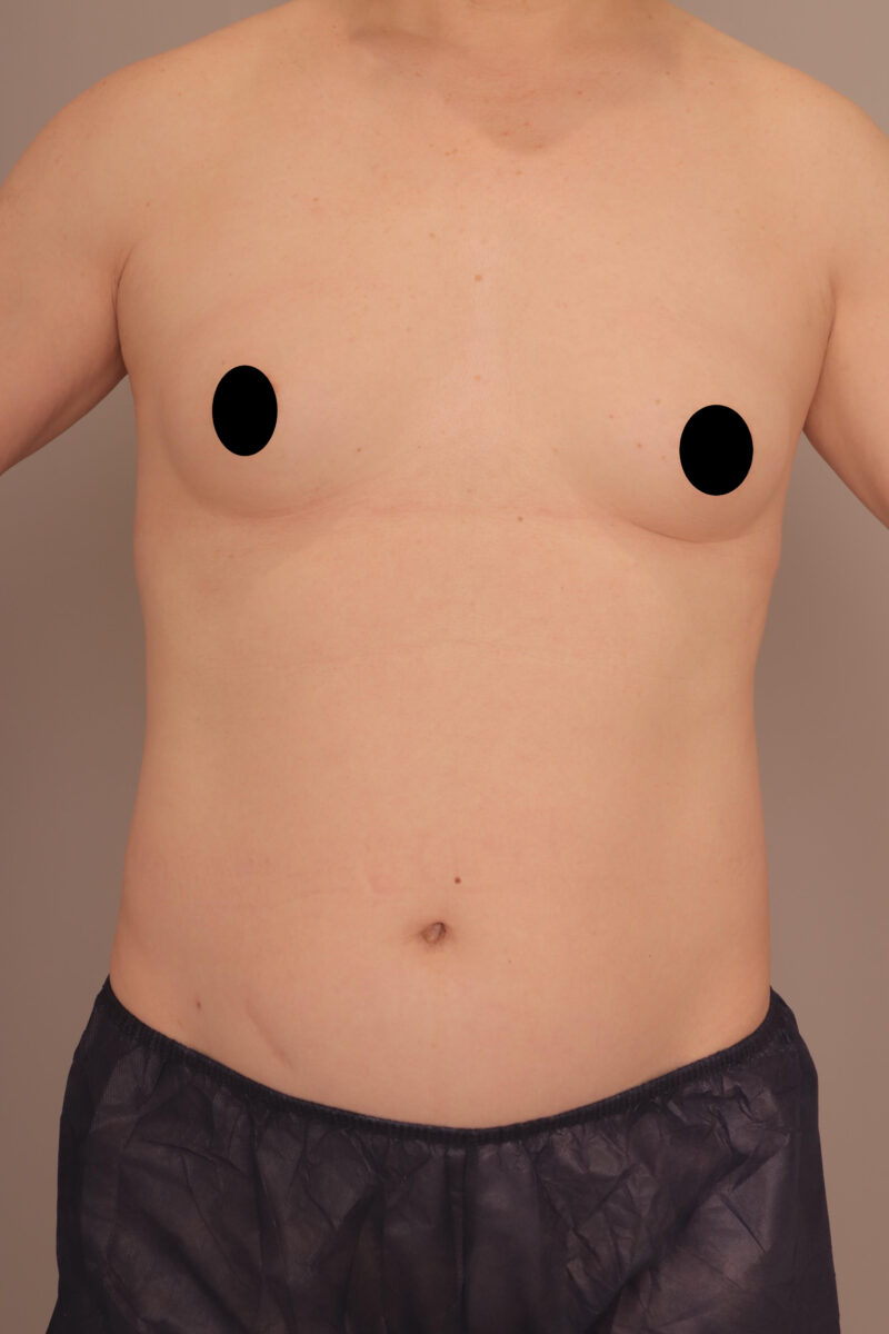 ベイザー脂肪吸引（半年後経過：58）の術前写真