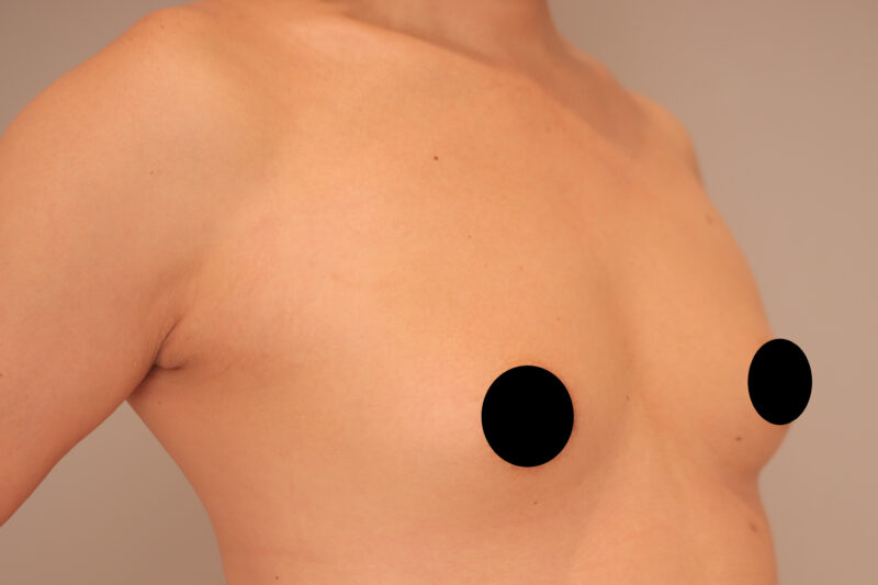 ベイザー脂肪吸引（2年後経過：54）の術前写真