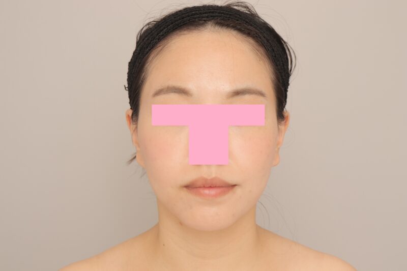 ベイザー脂肪吸引（6か月経過：30）の術後写真