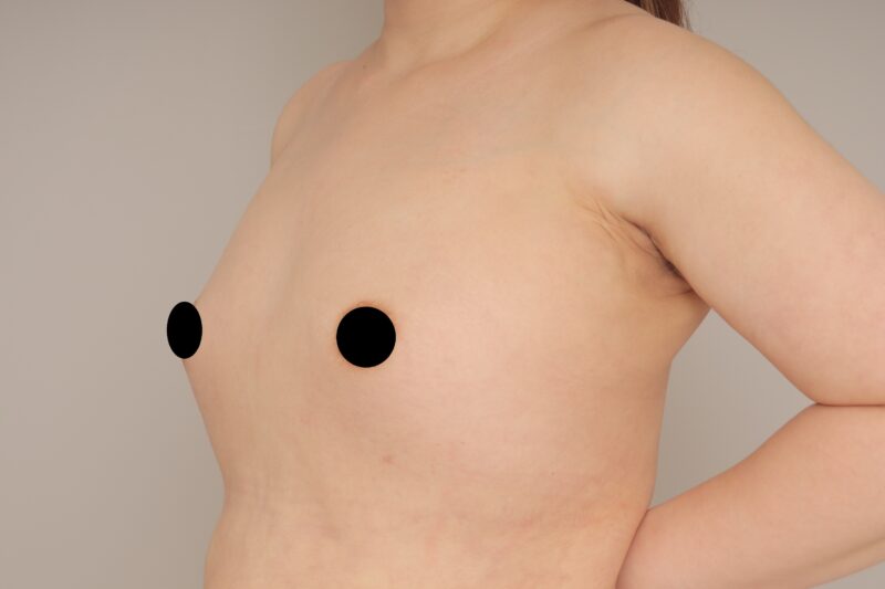 ベイザー脂肪吸引（6か月経過：38）の術前写真