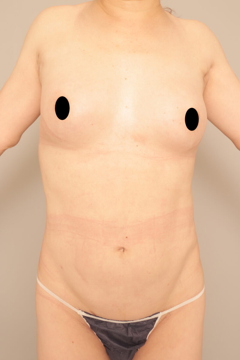 ベイザー脂肪吸引（半年後経過：58）の術後写真