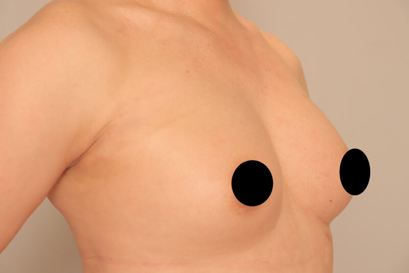 ベイザー脂肪吸引（2年後経過：54）の術後写真