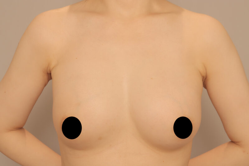 ベイザー脂肪吸引（1年2ヶ月後経過：45）の術後写真