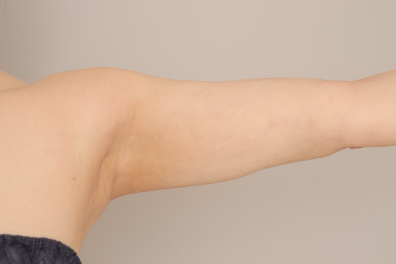 ベイザー脂肪吸引（6か月経過：41）の術後写真