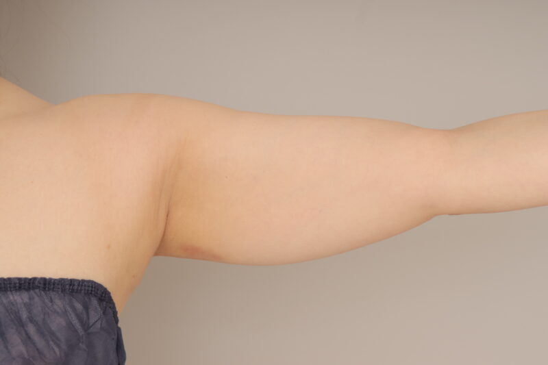 ベイザー脂肪吸引（6か月経過：41）の術前写真