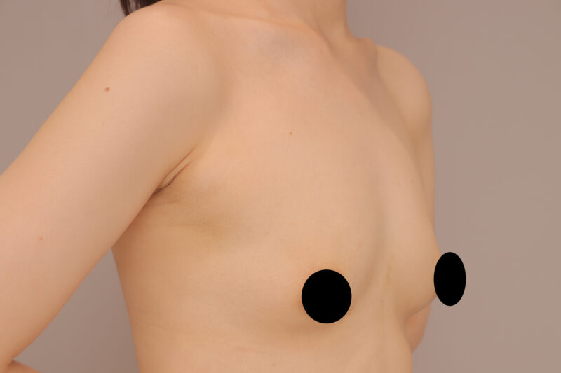 ベイザー脂肪吸引（1年2ヶ月後経過：45）の術前写真