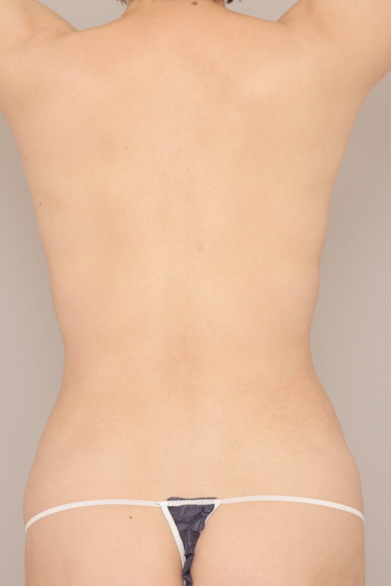 ベイザー脂肪吸引（3か月経過：49）の術後写真