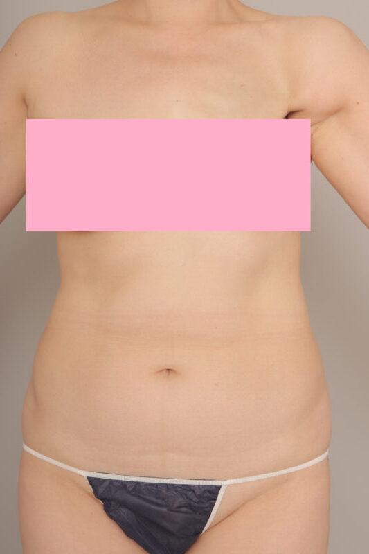 ベイザー脂肪吸引（6か月経過：49）の術前写真