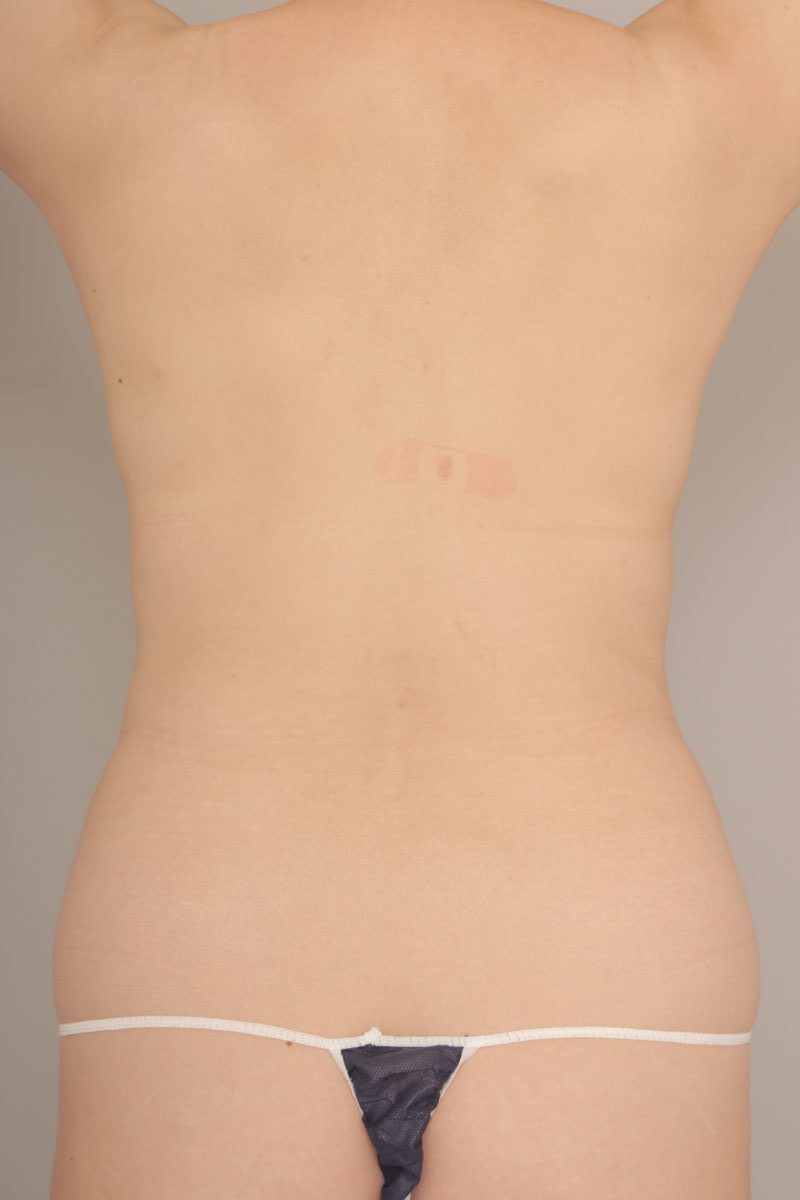 ベイザー脂肪吸引（3か月経過：49）の術前写真