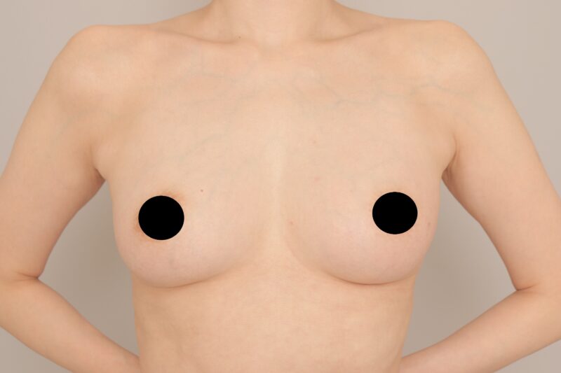 ベイザー脂肪吸引（3か月経過：43）の術後写真