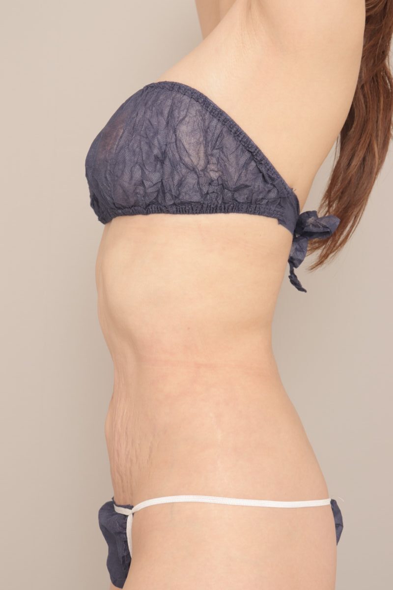 ベイザー脂肪吸引（3か月経過：43）の術後写真